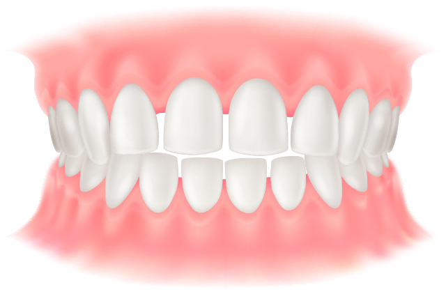 空隙歯列