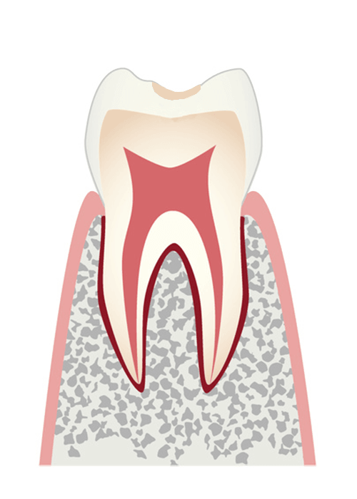 歯の表面にできた初期のむし歯