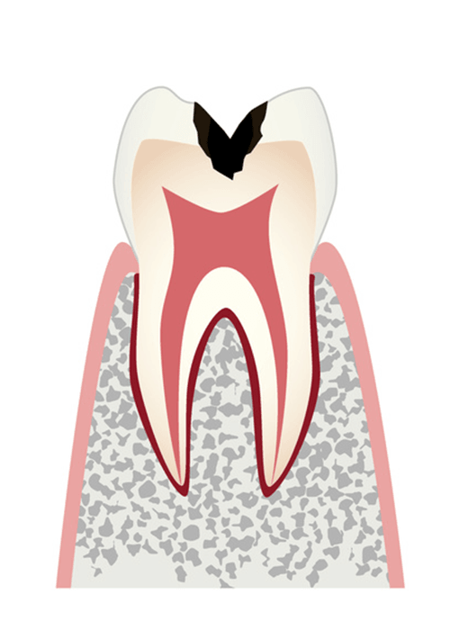エナメル質を突破され、象牙質に侵入されたむし歯