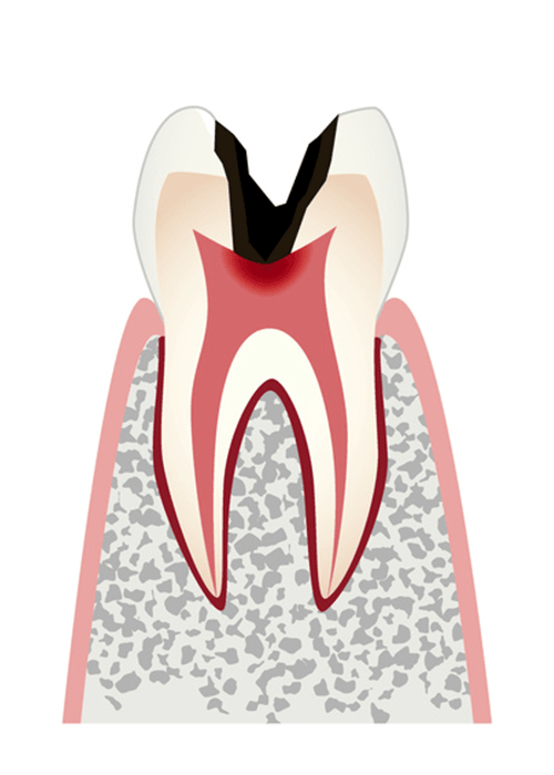 神経まで到達するむし歯